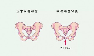 耻骨在哪个位置 耻骨在哪个位置的图片 孕妇孕中期耻骨疼