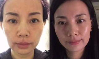 美容除皱方法 美容除皱纹的方法