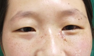 眼角有痣代表什么 女人眼角有痣代表什么