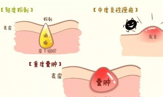 怎样处理青春痘（怎样处理青春痘比较好）