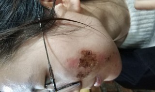 水痘坑的修复方法（水痘坑修复最有效的方法）