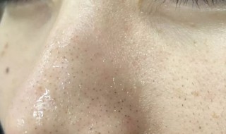 怎样去鼻子黑头 如何去掉鼻子上的黑头