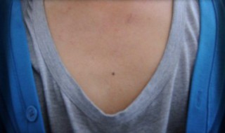 胸前有痣代表什么 女人左胸前有痣代表什么