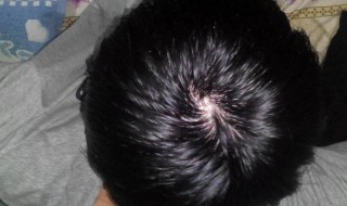 脱发了如何能让头发再生 脱发有什么好办法让头发再生