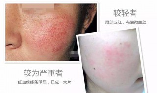 红血丝怎样去除（大腿上的红血丝怎样去除）