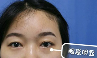 有什么祛眼袋的好方法 请问什么祛眼袋的小方法