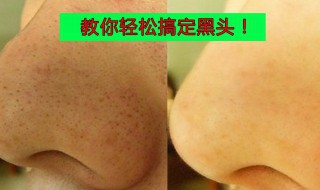 清理黑头最有效的方法 清理黑头最好的方法