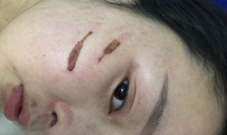 去疤去印的方法 去疤去印的方法有哪些