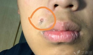脸上哪些痣不能去掉 脸上哪些痣不能去掉风水